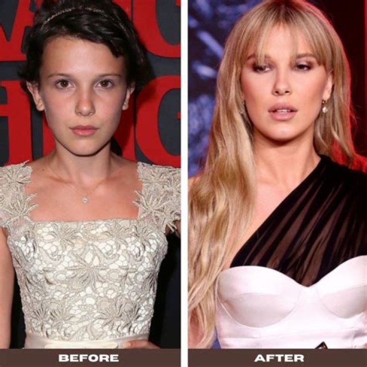 Did Millie Bobby Brown Undergo Nose Job And Lip Filler? Truths About Her Plastic Surgery