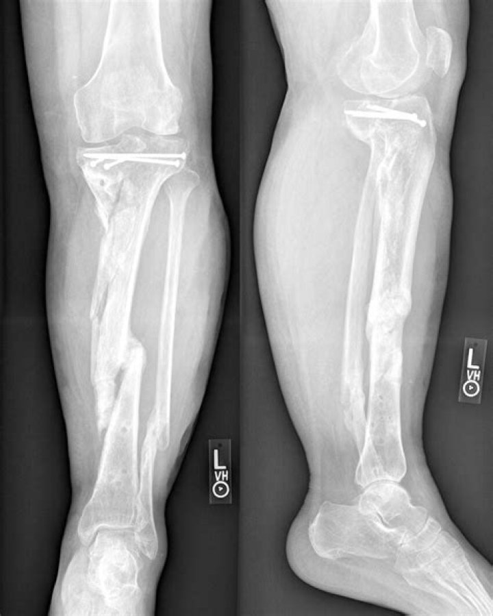 
Georginio Wijnaldum At Risk Of Missing World Cup After Suffering Fractured Tibia 