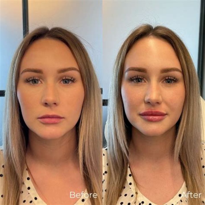 
Loose Women’s Carol McGiffin’s Botox And Lip Filler: Before And After Plastic Surgery Photos Explored! 