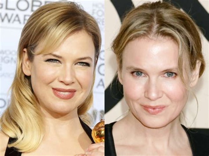 
Renee Zellweger Before And After Plastic Surgery Pictures 