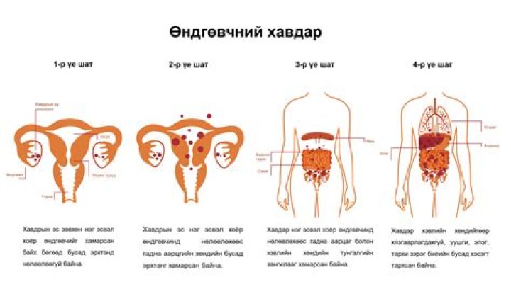 
Who Is Hannah Catton? How Are Ovarian Cancer and Weight Gain Related? 